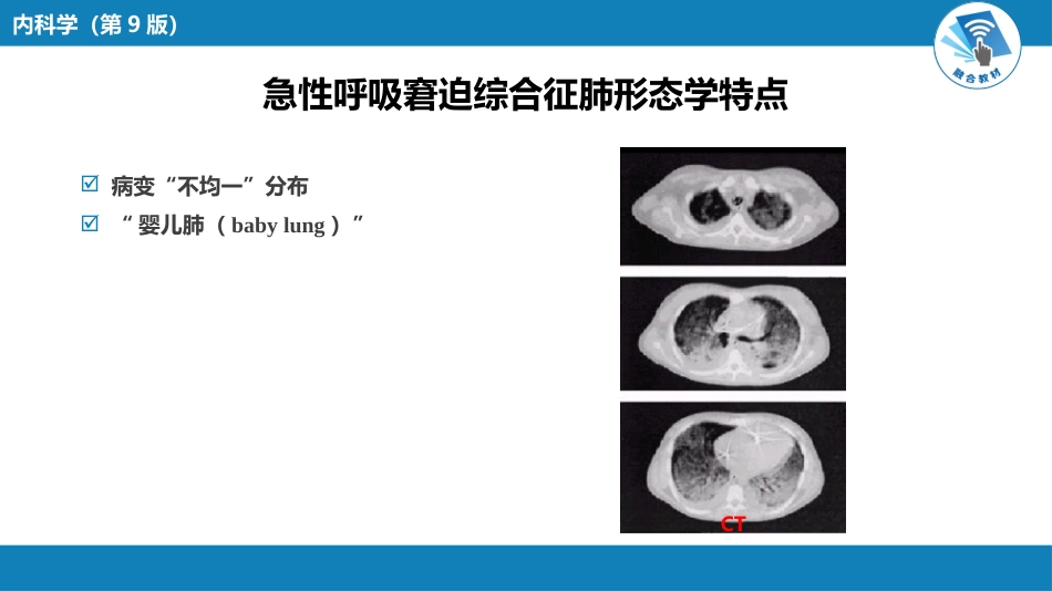 呼吸系统疾病：急性呼吸窘迫综合征_第9页