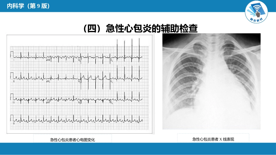 心内科：心包疾病_第10页