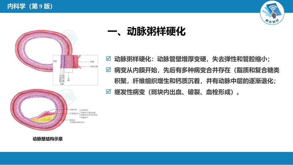 心内科： 动脉粥样硬化和冠状动脉粥样硬化性心脏病_第5页
