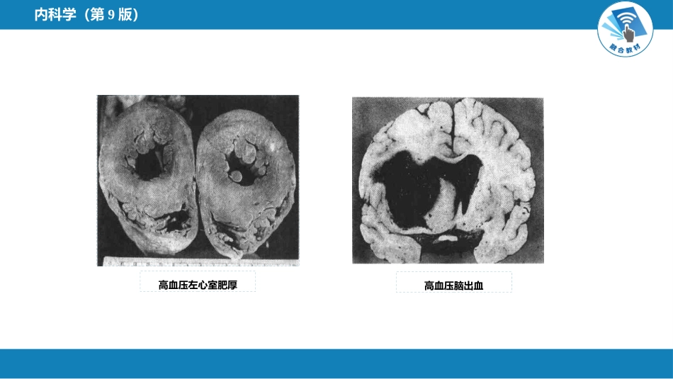 心内科：高血压_第12页