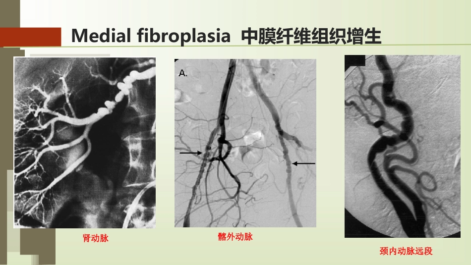 肌纤维发育不良_第12页
