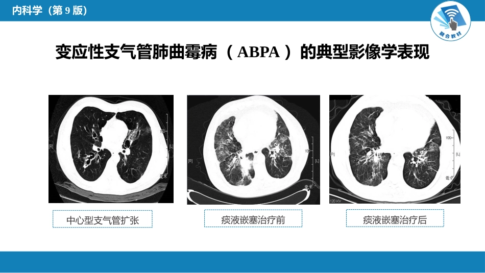 呼吸系统疾病： 肺部感染性疾病_第10页