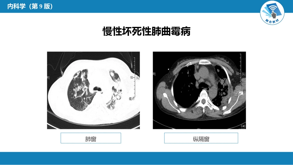 呼吸系统疾病： 肺部感染性疾病_第11页