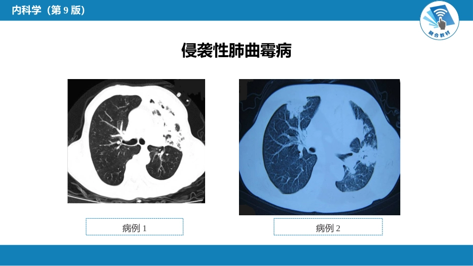呼吸系统疾病： 肺部感染性疾病_第12页