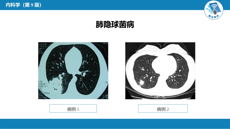 呼吸系统疾病： 肺部感染性疾病_第13页