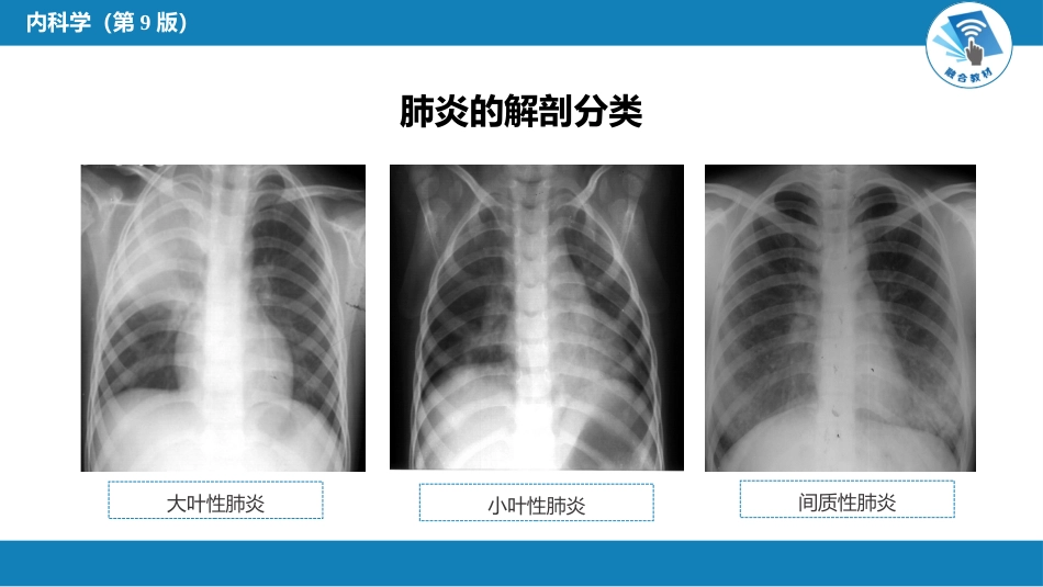 呼吸系统疾病： 肺部感染性疾病_第5页