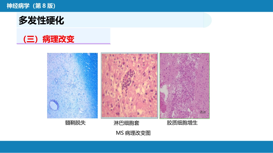第十三章 中枢神经系统脱髓鞘疾病_第6页