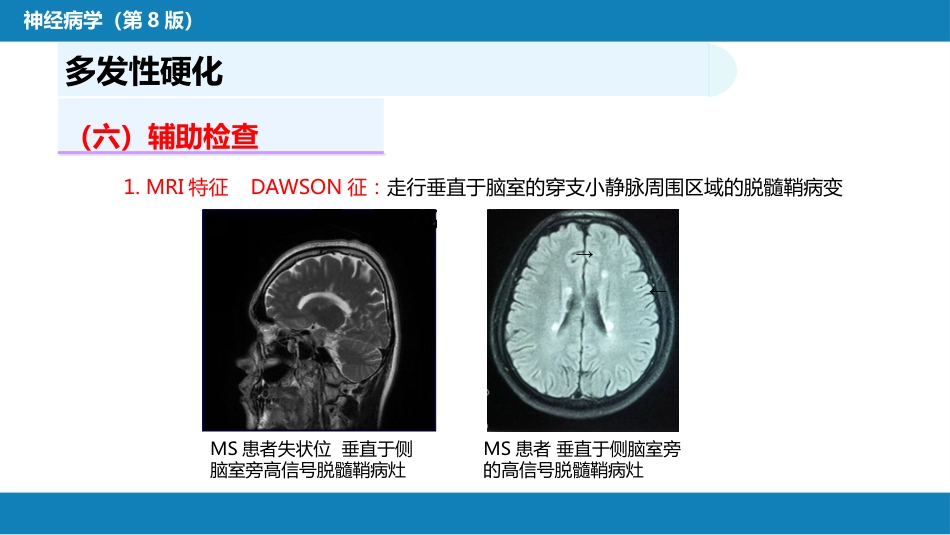 第十三章 中枢神经系统脱髓鞘疾病_第9页