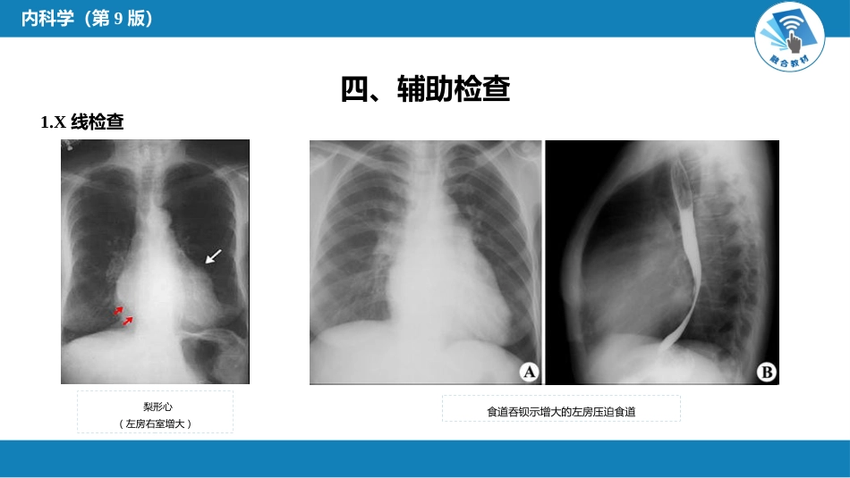 心内科：心脏瓣膜病_第14页