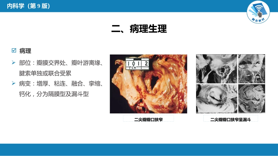 心内科：心脏瓣膜病_第7页
