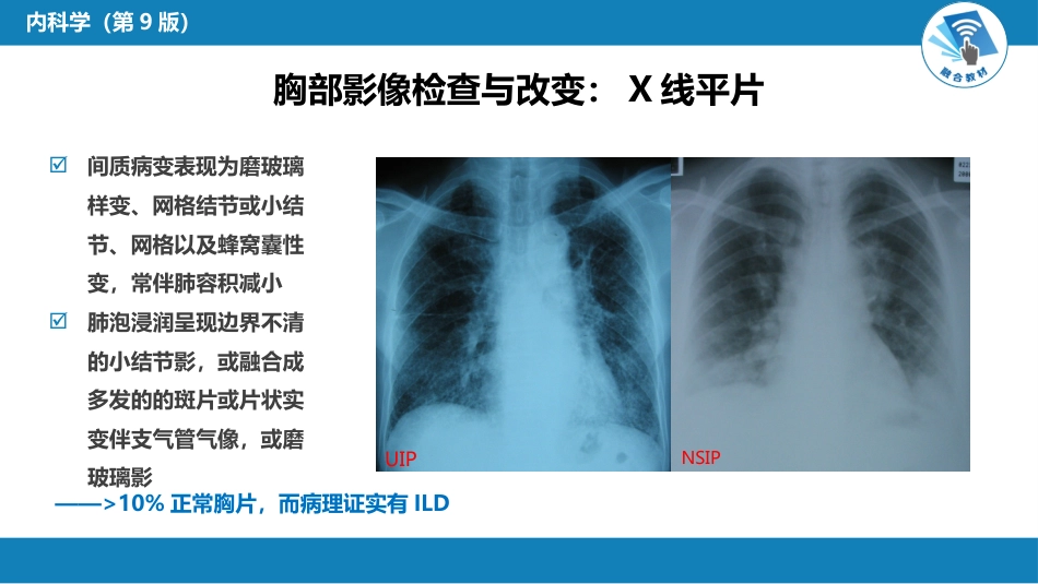 呼吸系统疾病：间质性肺疾病_第12页