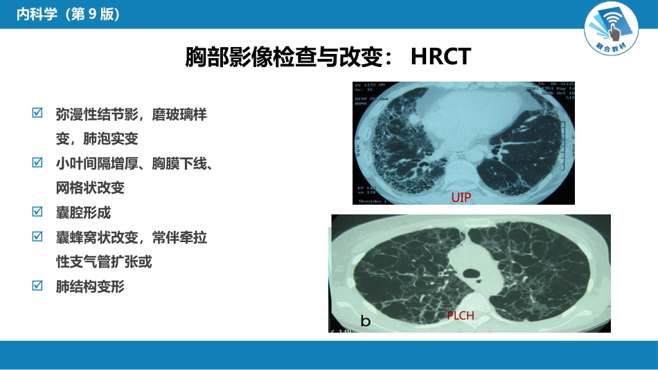 呼吸系统疾病：间质性肺疾病_第13页