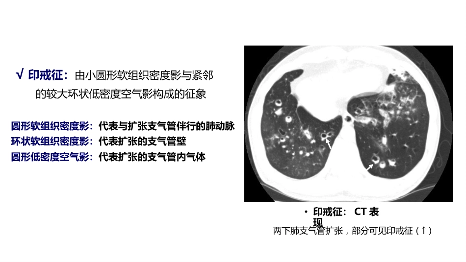 呼吸系统——支气管扩张症、肺炎_第12页