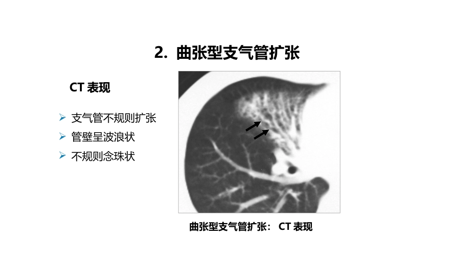 呼吸系统——支气管扩张症、肺炎_第14页