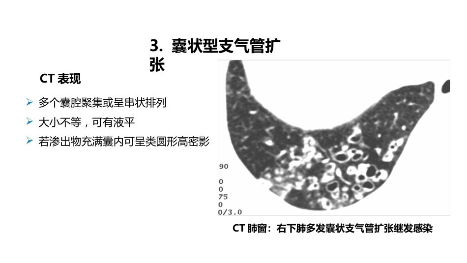 呼吸系统——支气管扩张症、肺炎_第15页