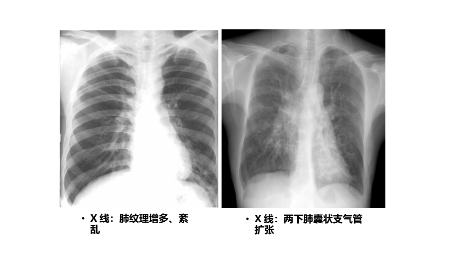 呼吸系统——支气管扩张症、肺炎_第9页