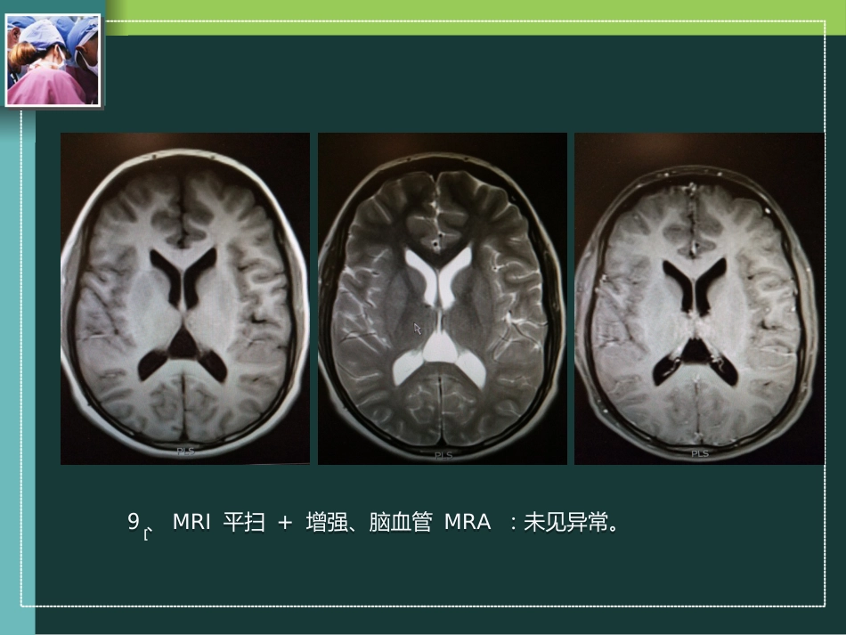 复发性无菌性脑膜炎_第8页