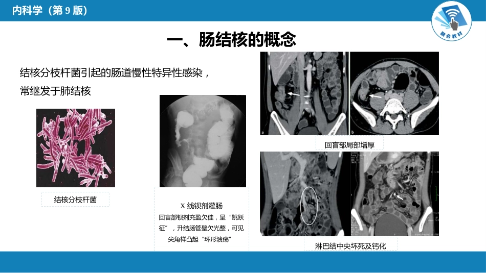 消化内科：肠结核和结核性腹膜炎_第5页