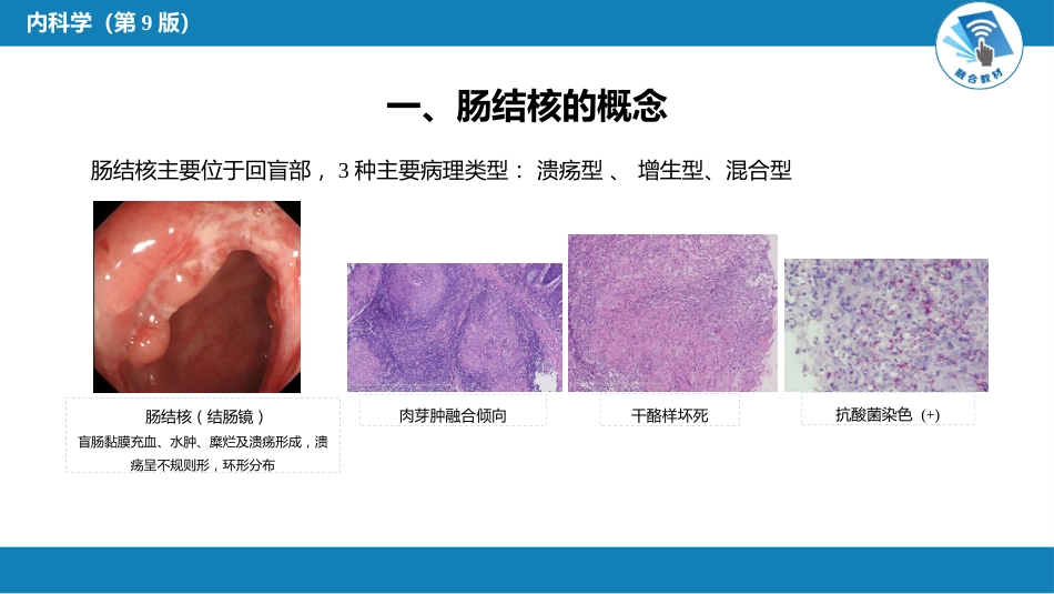 消化内科：肠结核和结核性腹膜炎_第6页