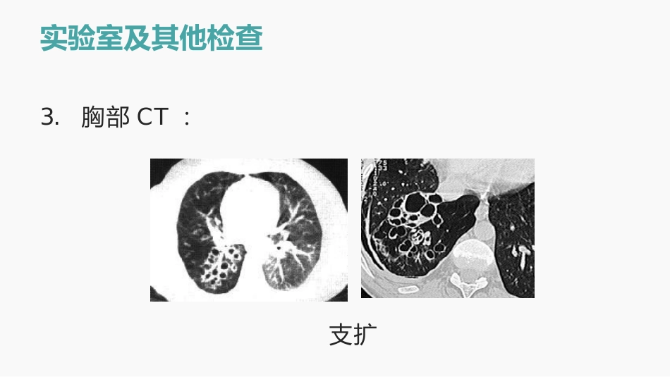支气管扩张的护理查房_第15页
