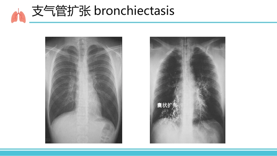 支气管扩张病人的护理1_第6页