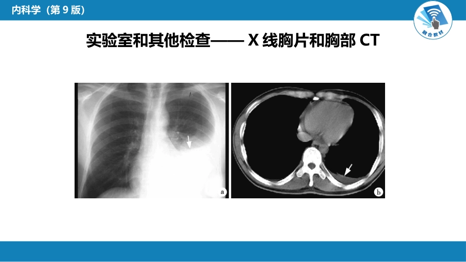 呼吸系统疾病：胸膜疾病_第14页