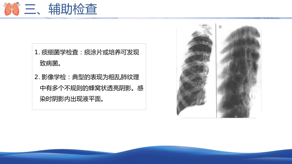 支气管扩张病人的护理2_第11页