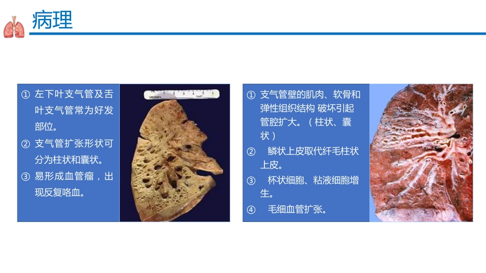 支气管扩张症2_第9页