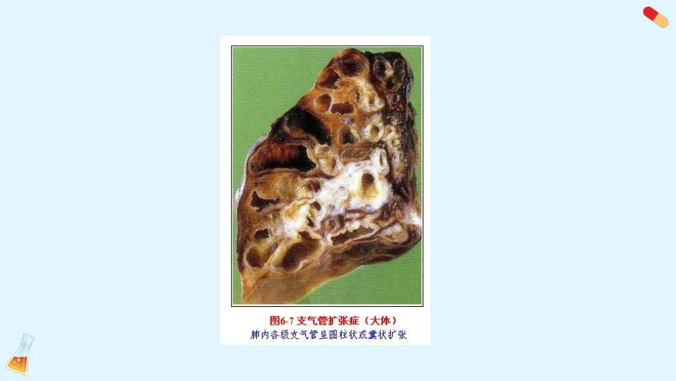 支气管扩张3_第11页