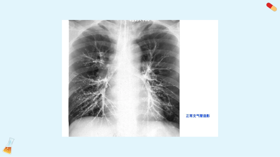支气管扩张3_第5页