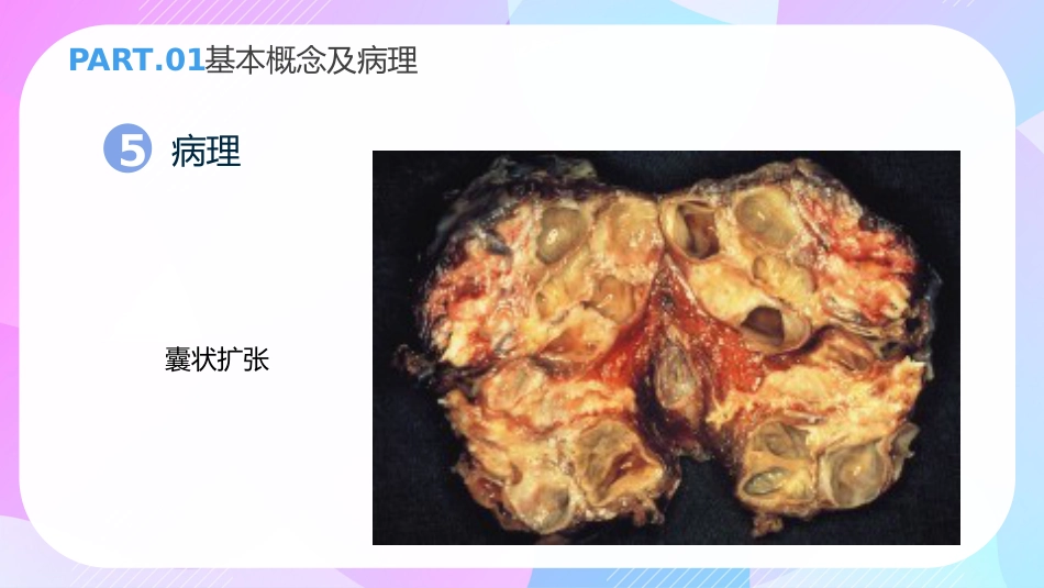 支气管扩张症3_第10页
