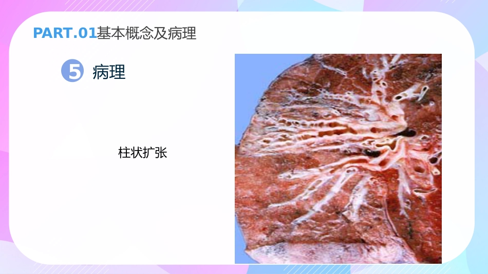 支气管扩张症3_第11页