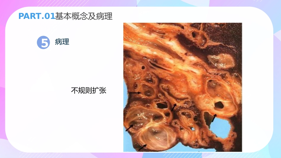 支气管扩张症3_第12页