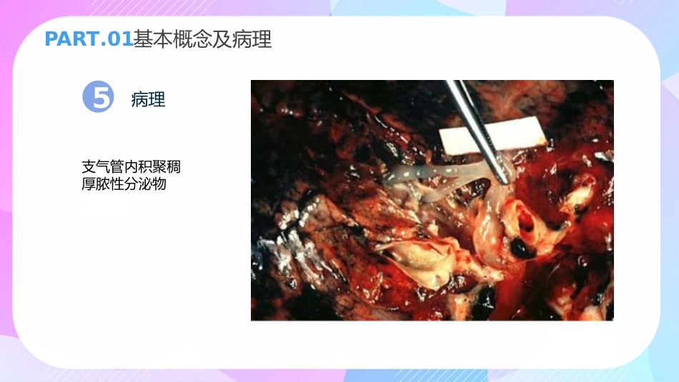 支气管扩张症3_第13页