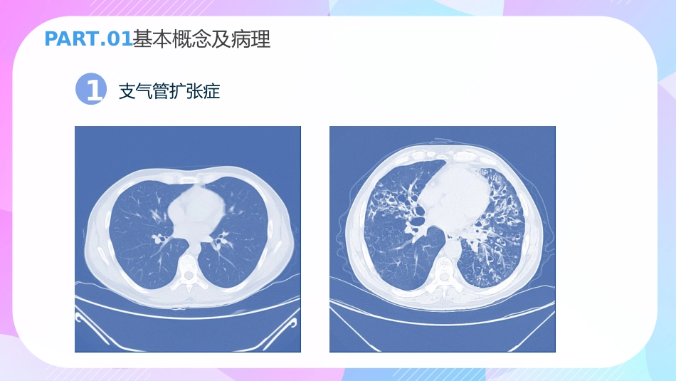 支气管扩张症3_第6页