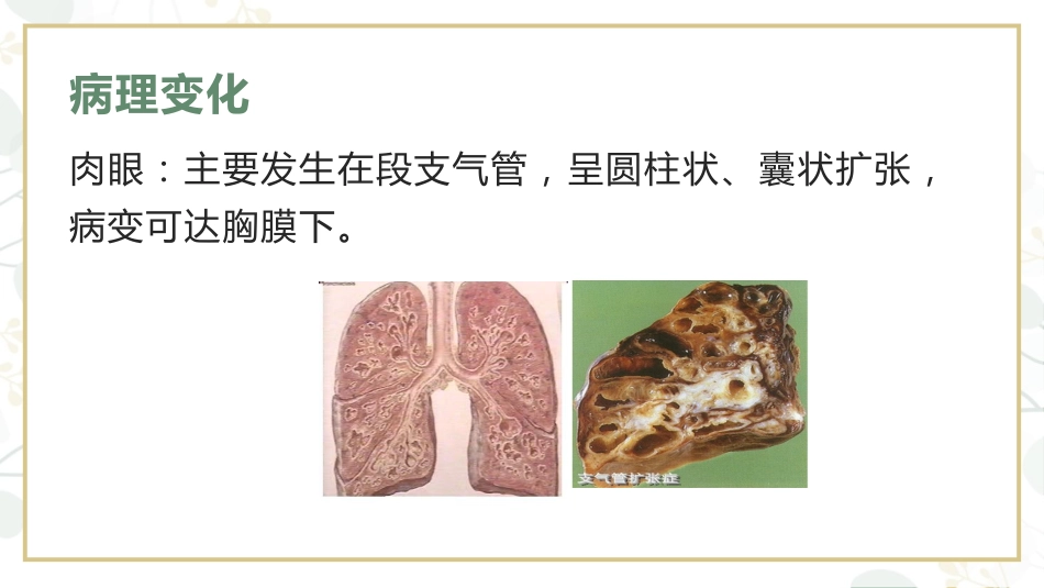 支气管扩张病人的护理4_第7页