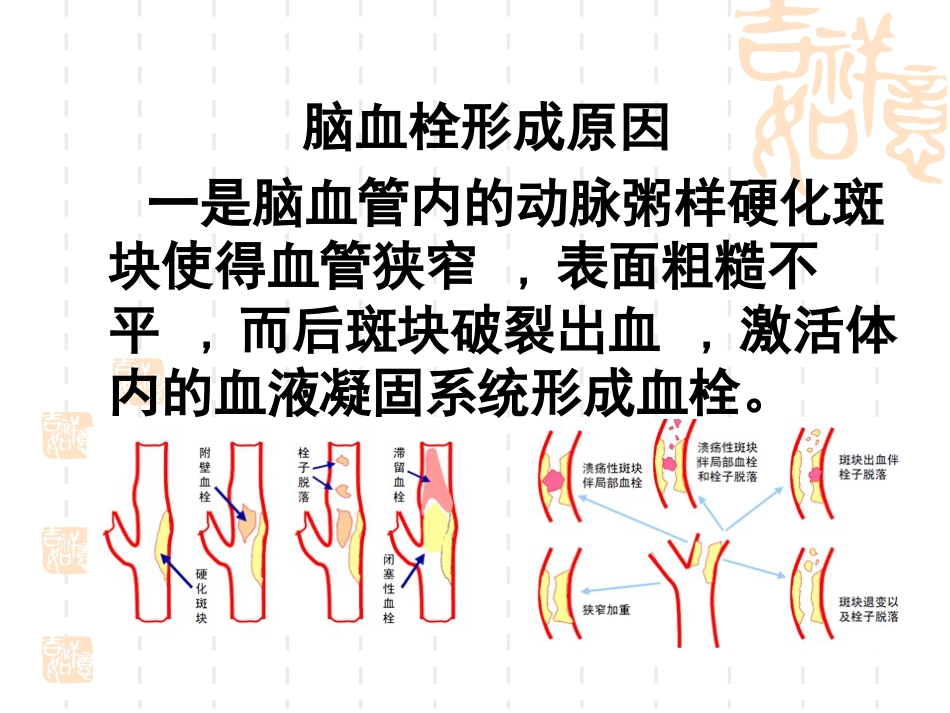 神经内科脑血栓_第6页