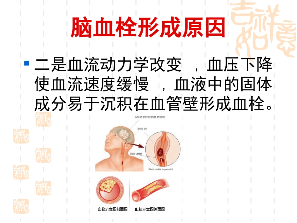 神经内科脑血栓_第7页