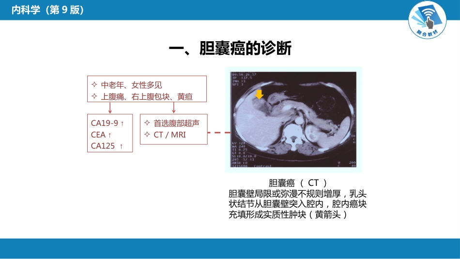 消化内科：胆道系统肿瘤_第7页
