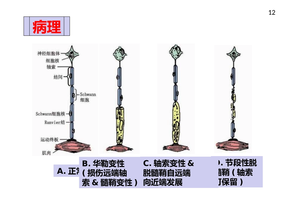 周围神经病_第12页