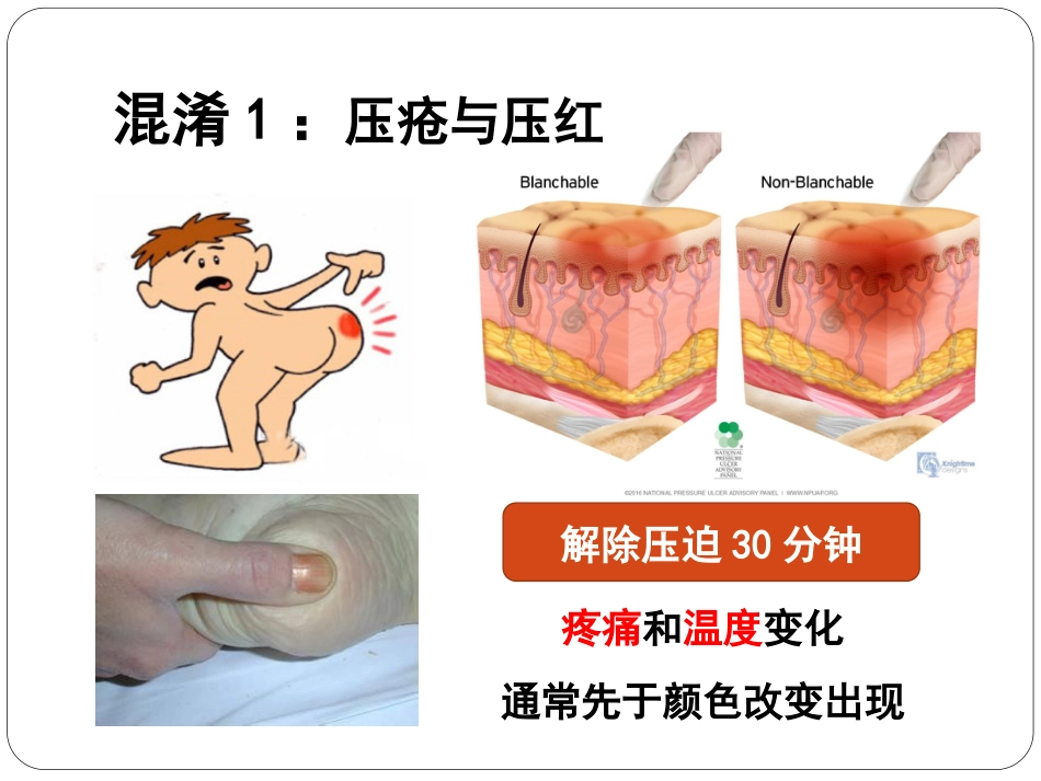 压疮_第4页