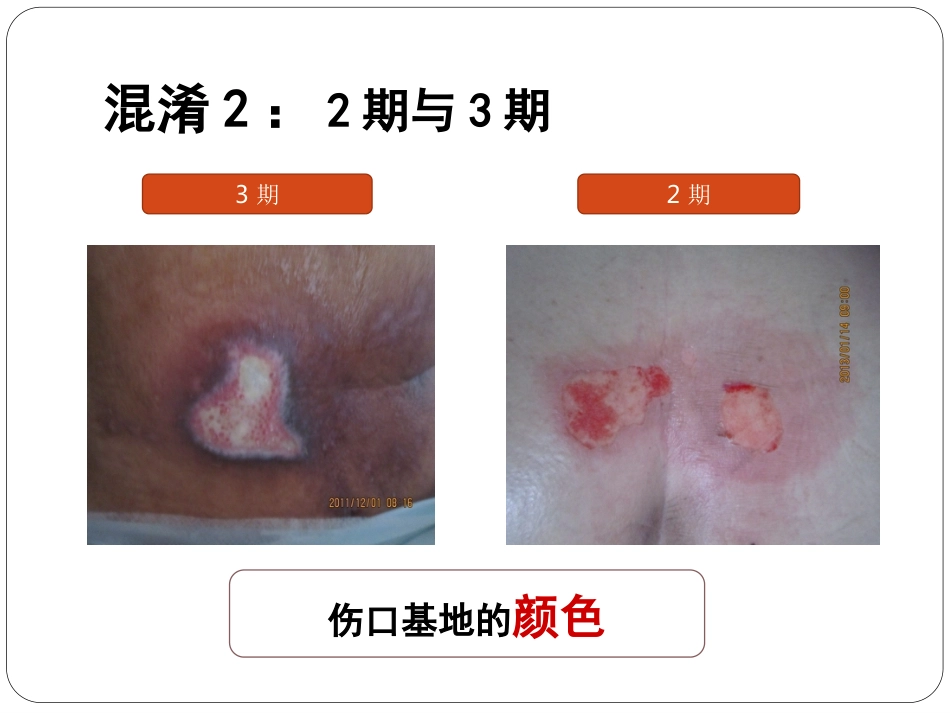 压疮_第5页