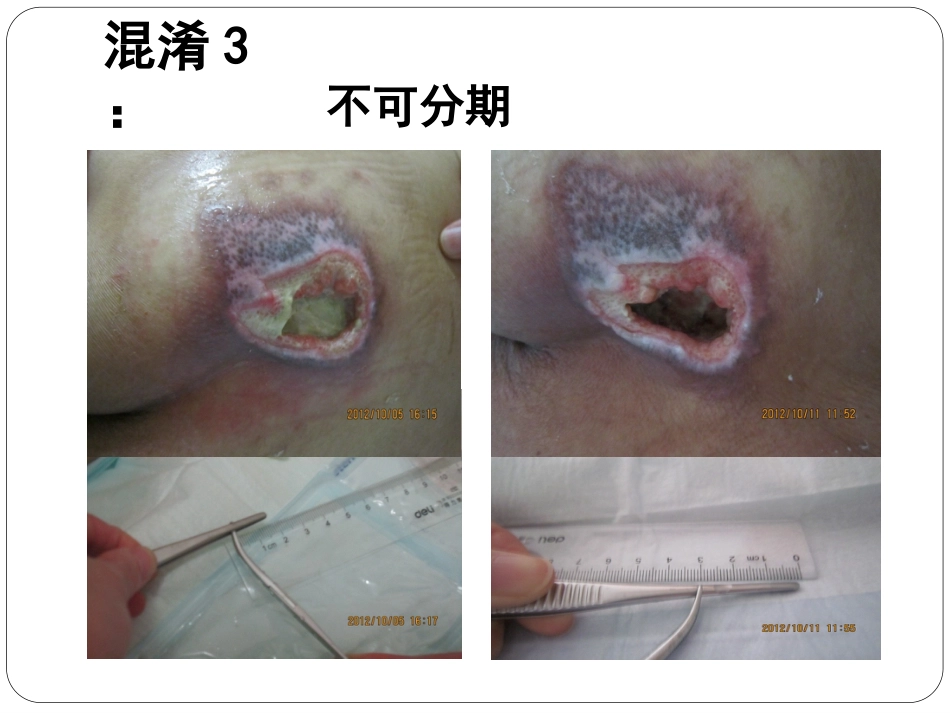 压疮_第6页