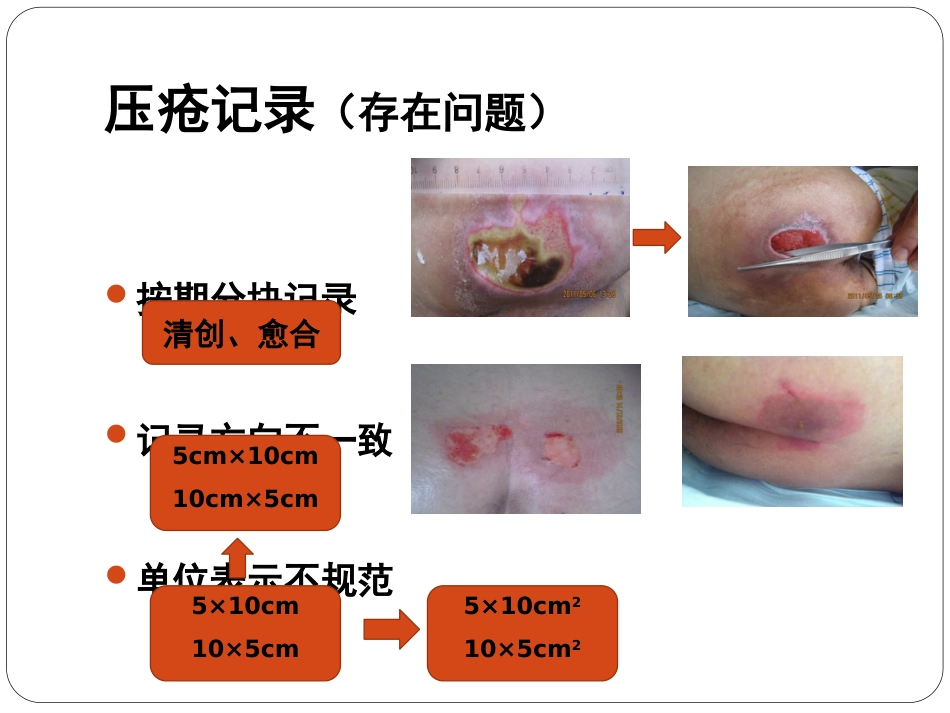 压疮_第8页