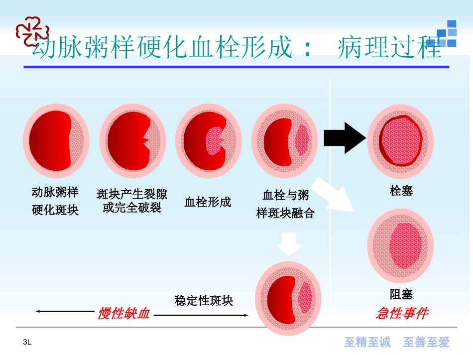 脑梗死（新）及脑出血_第10页