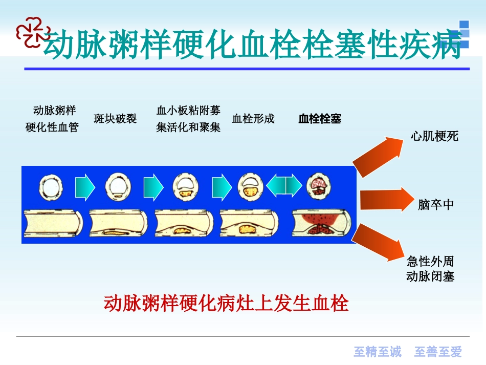 脑梗死（新）及脑出血_第11页