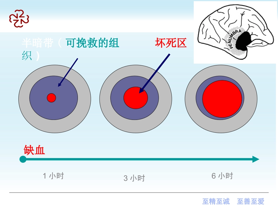 脑梗死（新）及脑出血_第13页