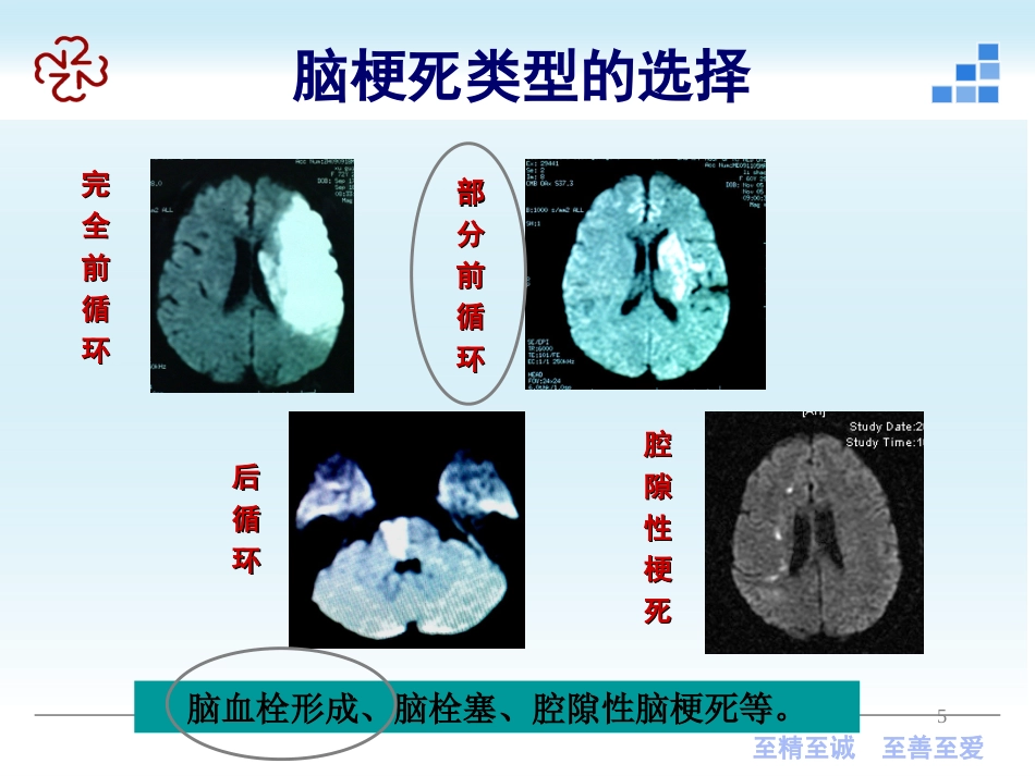 脑梗死（新）及脑出血_第5页
