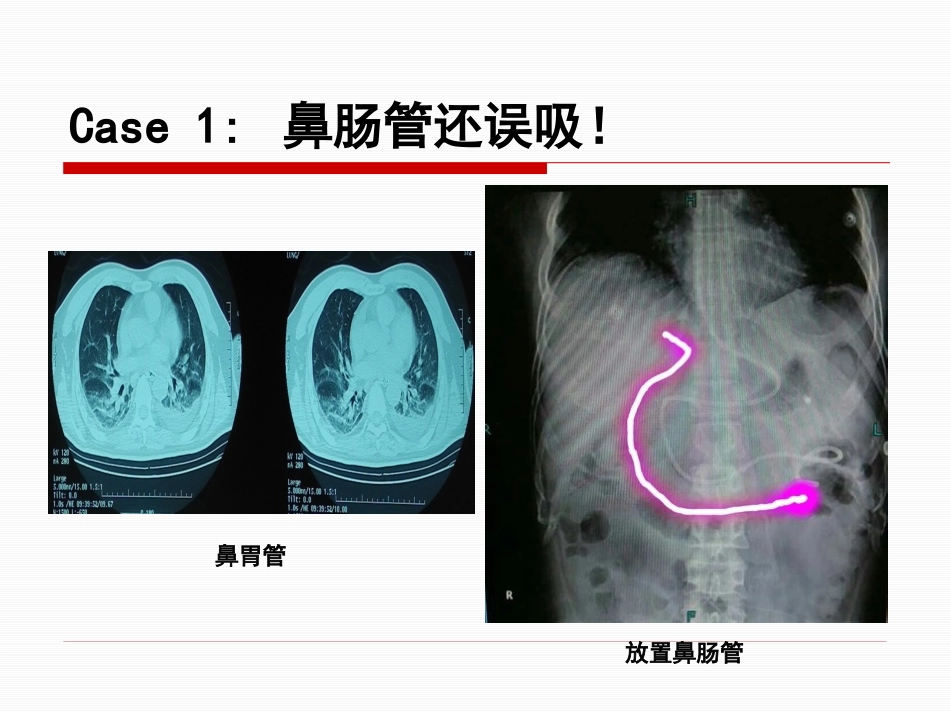 神经重症患者康复期肠内营养途径选择_第11页