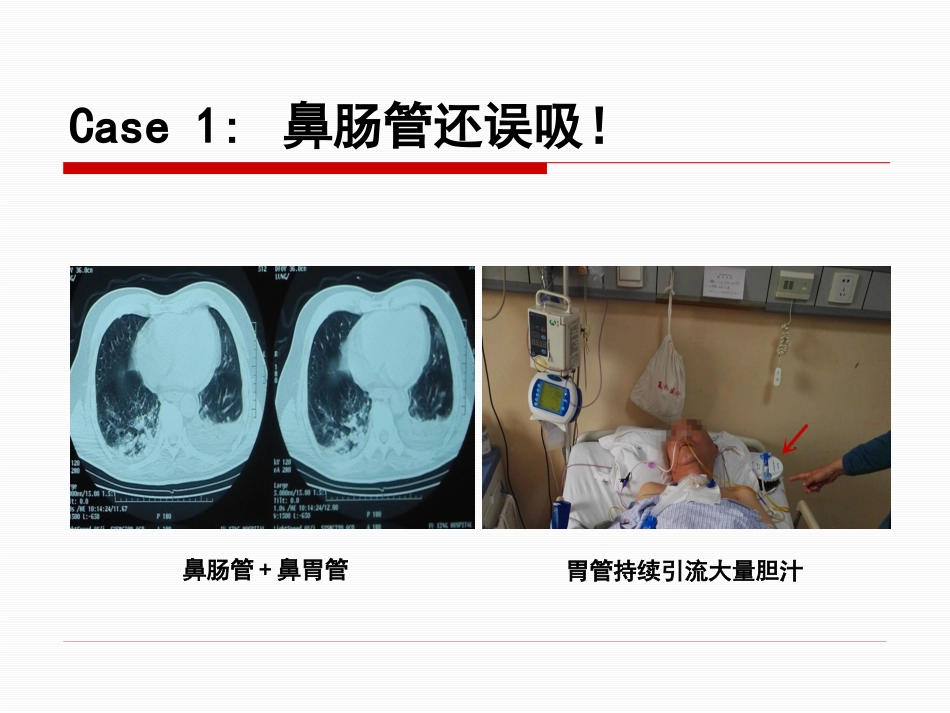 神经重症患者康复期肠内营养途径选择_第12页